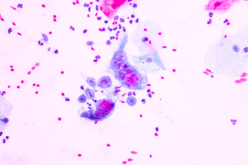 Fototapeta premium Genital herpes infection by the herpes simplex virus (HSV) of the genitals.Ground glass appearance criteria for pap smear slide cytology and pathology.Human cell medical concept.