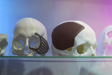 Layout of the human skull with implants made using 3D printing technology