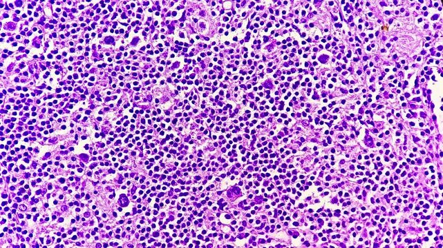 Photomicrographic footage of a lymph node in a patient with Hodgkin's lymphoma