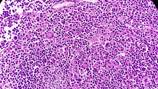 Photomicrographic footage of a lymph node in a patient with Hodgkin's lymphoma