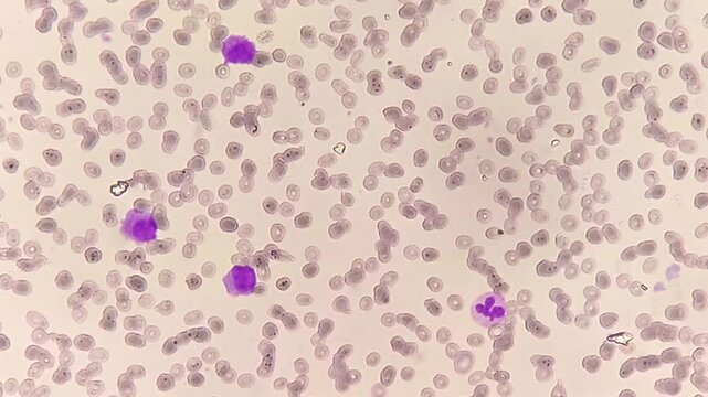Photomicrographic footage showing Marginal Zone Lymphoma with thrombocytopenia, a rare type of non-Hodgkin lymphoma