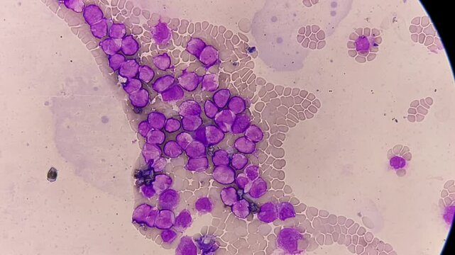 Photomicrographic footage showing Marginal Zone Lymphoma with thrombocytopenia, a rare type of non-Hodgkin lymphoma