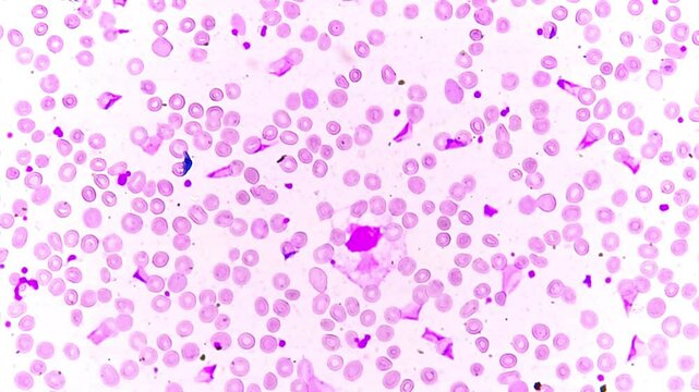 Peripheral blood smear under microscope, the RBCs show anisocytosis, poikilocytosis, hypochromia and target cells may be due to the iron deficiency anemia, Thalassemia or Liver disease.