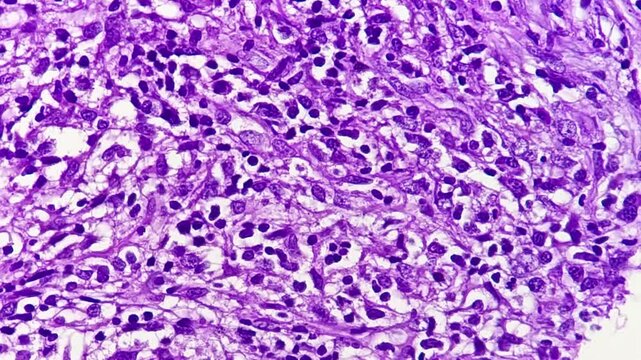 Mixed cellularity classic Hodgkin lymphoma (MCCHL), a subtype of classic Hodgkin lymphoma characterized by Hodgkin, Reed Sternberg cells in a diffuse mixed inflammatory background