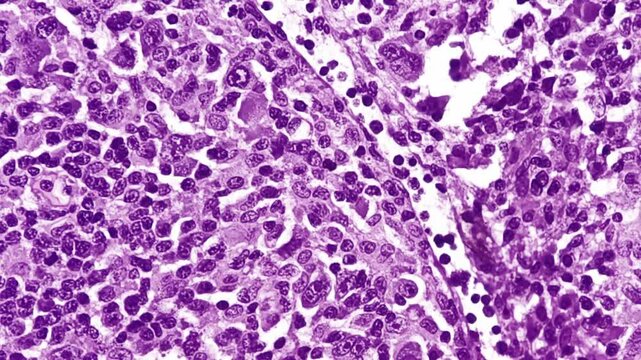 Mixed cellularity classic Hodgkin lymphoma (MCCHL), a subtype of classic Hodgkin lymphoma characterized by Hodgkin, Reed Sternberg cells in a diffuse mixed inflammatory background