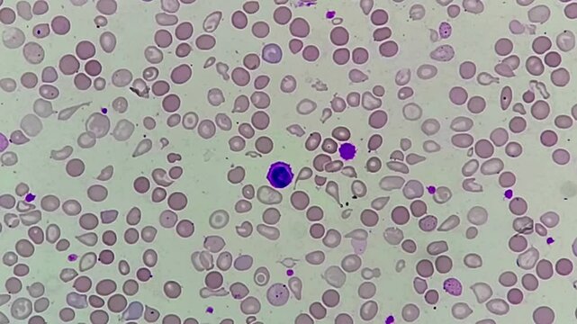Hematological slide of Microscopic image showing severe microcytic hypochromic anemia. nRBC, Tear drop cell and others abnormal RBC present