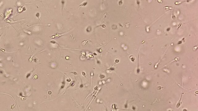 Medical footage, Pyospermia medical term, a high number of white blood cells or pus cell in semen. It can weaken sperm and affect fertility