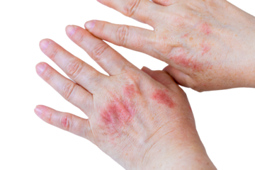 atopic dermatitis. red, itchy, woman's hands. Cracked skin and allergic wounds on hands. Medical concept