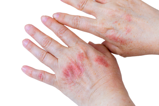 atopic dermatitis. red, itchy, woman's hands. Cracked skin and allergic wounds on hands. Medical concept