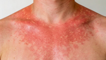 Fototapeta premium Body Skin Condition with Red Irritation and Rash on Chest Area and Shoulders