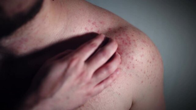 Concept of eczema, psoriasis or dermatitis, red small pimples on chest and shoulder, allergy reaction on skin surface, epidermis inflammation