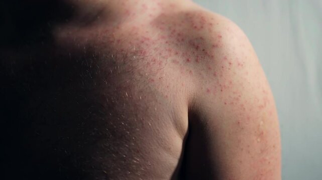 Man scratching his chest with hand because of strong itchy skin reaction, lots of small res pimples on human chest and shoulder, problem of incorrect hygiene, bacterial infection or allergy