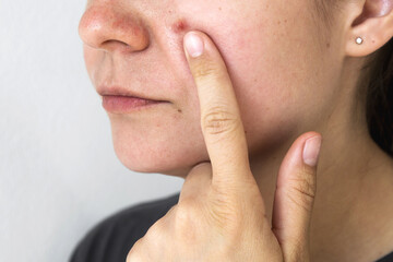 Woman touching an inflamed pimple on her cheek, showing skin imperfections and acne problems. Close-up of facial skin with redness and blemishes, highlighting dermatological issues