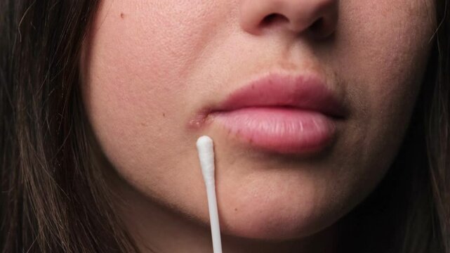 Close-up of a woman points a cotton swab to a cold sore on her lip, indicating treatment or care for a possible herpes simplex virus infection.