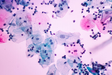 Abnormal squamous epithelial cells on white background view in microscopy.Atypical epithelial cells...