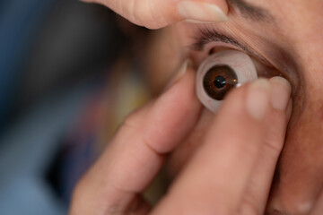 Ocularist placing prosthetic eye in patient's socket