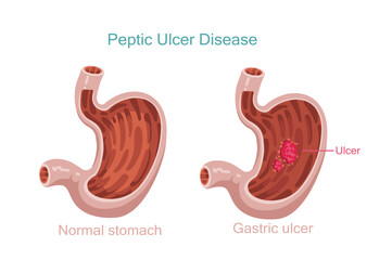 Peptic Ulcer Disease