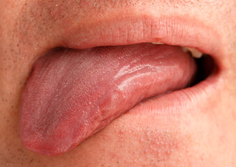 A man's tongue is red and swollen