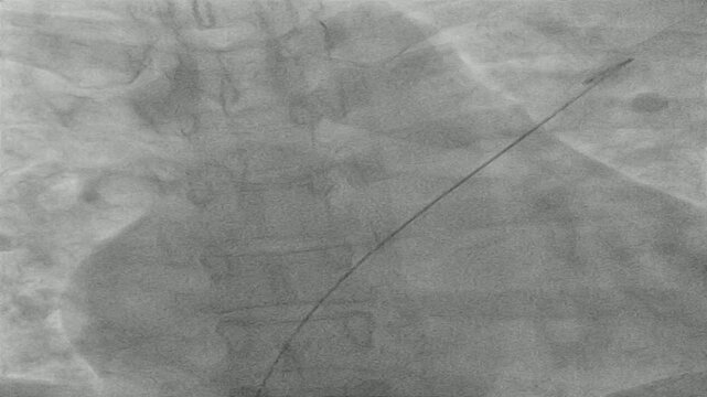 Atrial Septal Defect (ASD) Closure Procedure Using Invasive Cardiology Techniques and Closure Device