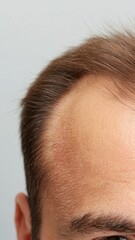 Fototapeta premium Close up of Man's Scalp with Dandruff, Brown Hair, Neutral Background
