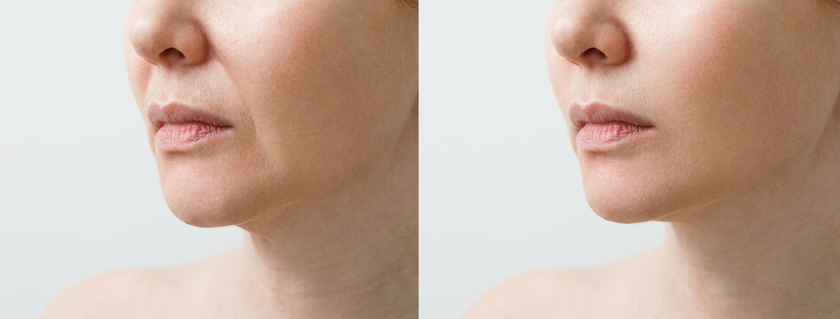 Female nasolabial fold before and after wrinkle smoothing procedures. Correction of the chin and neck shape. The result of the rejuvenation procedure at the aesthetic medicine clinic.