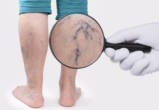 Doctor's hand in a white glove shows zoomed blood vessels with a magnifying glass. Old woman with vascular asterisks on her legs. Rear view. The concept of varicose veins.