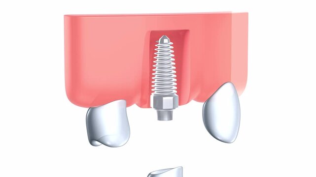3D animation of a dental implant in a realistic and anatomical graphic style. In two phases, before and after placement. Placed in the upper gum on a white background, showing the interior.