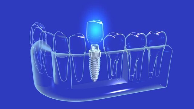 3D animation of a dental implant with light in a transparent glass graphic style. Showing the implant being placed in the anatomical gum on a blue background.