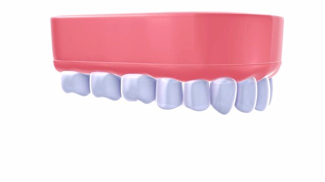 3D animation of a dental prosthesis in a realistic graphic style. Showing the action of placing it in a gum with dental implants, which is then rotated. On a white background.