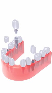 Vertical 3D animation of three dental implants being placed simultaneously in a gum. Featuring a realistic anatomical graphic style. Viewed from above with a white background.
