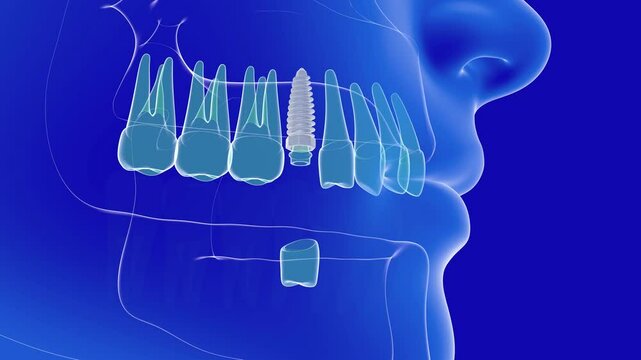 3D animation of a dental implant being placed in a denture. It is placed in a transparent glass gum, on top of an anatomical human head. The interior is shown on a blue background.