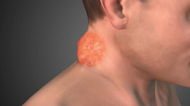 Anatomy of Abscess in the Neck