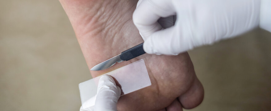 Medical procedure of scraping the skin of the foot for laboratory analysis and diagnosis of fungal infections. A doctor in sterile gloves takes a tissue sample using a scalpel and a slide