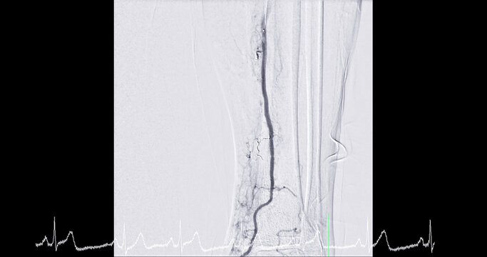 Femoral Angiogram of femoral artery showing femoral artery vessel isolated on white background for diagnosis atherosclerosis.