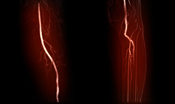 Femoral Angiogram of femoral artery showing femoral artery vessel isolated on white background for diagnosis atherosclerosis.