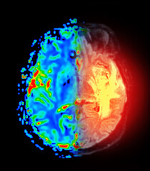MRI brain perfusion imaging helps assess cerebral blood flow and tissue viability.