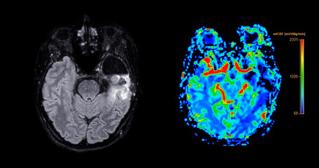 MRI brain perfusion imaging helps assess cerebral blood flow and tissue viability.