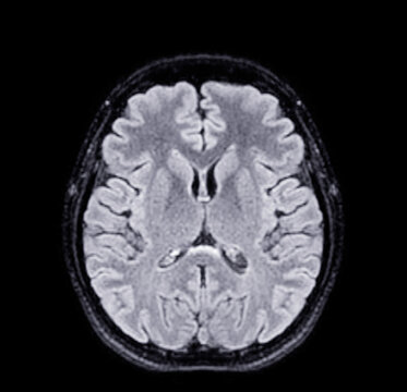 MRI brain scans axial view offer valuable insights into brain anatomy, functioning, and pathology for accurate medical assessments.