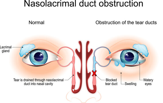 Nasolacrimal duct obstruction. Dacryocystitis. Cross section of Tear ducts