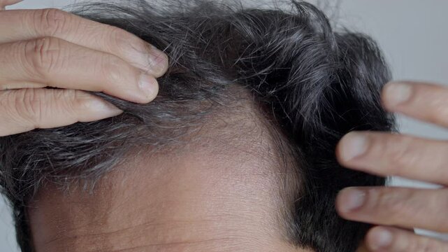 Hair loss, male pattern baldness, visible scalp. Man with androgenic alopecia hairloss disease.