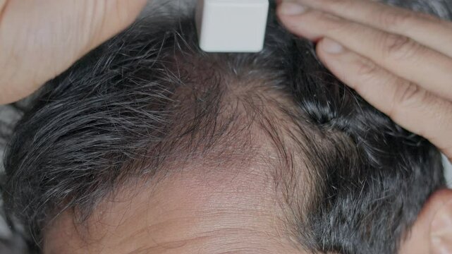 Collagen induction therapy, man using derma stamp on head to improve hair regrowth.