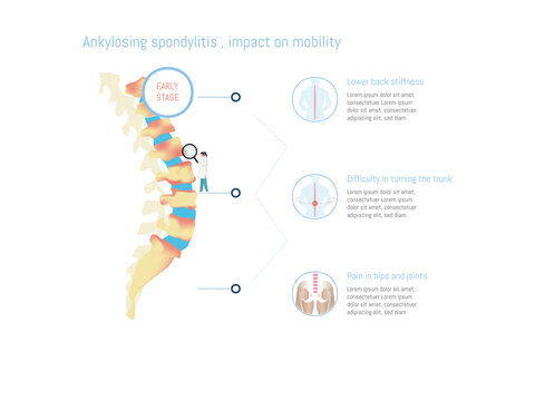 Doctor analyzing ankylosing spondylitis effects on spine mobility, highlighting lower back stiffness, difficulty turning trunk, and hip pain
