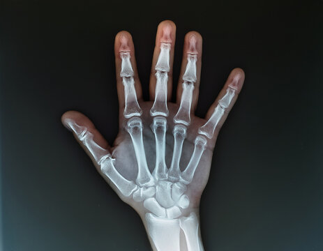 Radiographic view of human hand, displaying metacarpal and phalange bones. Skeletal system