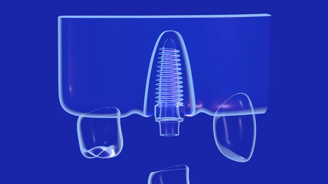 3D animation of a dental implant with a screw in a transparent and anatomical graphic style. With internal light. Placed in the glass gum on a blue background, showing the interior.