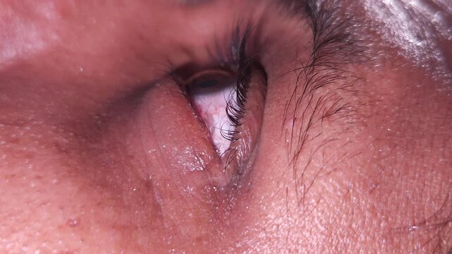 A woman uses eye drops