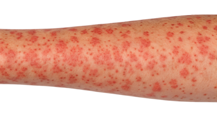 Measles Vitamin A Treatment Measles can cause rash that requires vitamin treatment for recovery and proper care