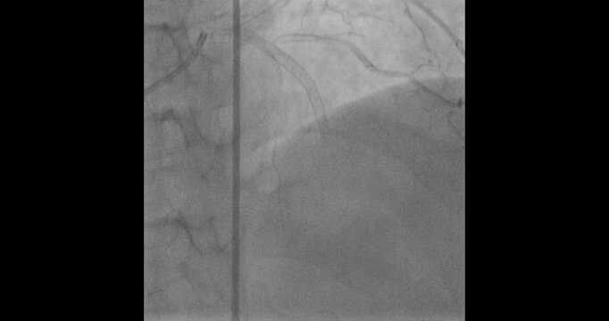 Coronary Angiogram Demonstrating LAD Stent Blockage Months After Placement