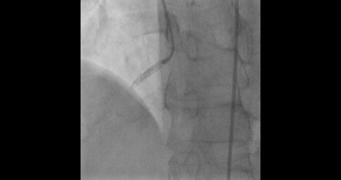 Coronary Angiogram Showing RCA and LAD Stents Placement
