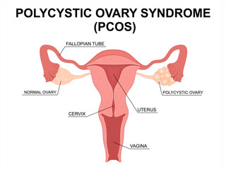 Cross-Section of Female Reproductive System with Polycystic Ovary Syndrome (PCOS). Polycystic ovary and Healthy Ovary. Uterus internal view. 