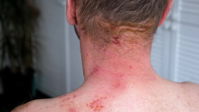 Skin lesion symptom in Shingles or Herpes zoster in person. Viral disease Varicella virus. Painful skin rash with blisters on the body. Red pimples. Insects bite. Body injury. High quality 4k footage.